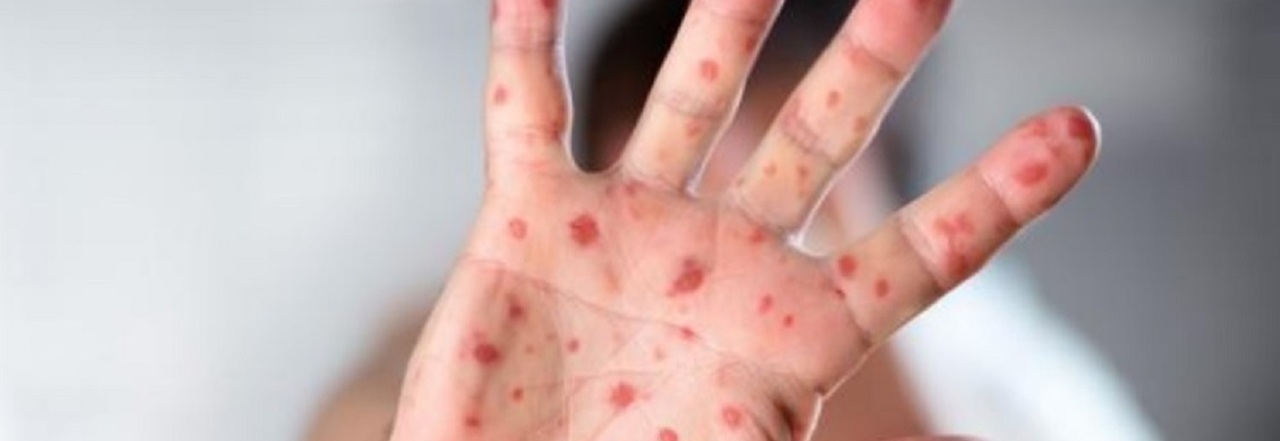 Morbillo Boom Di Casi In Europa E Asia Centrale Da Gennaio I