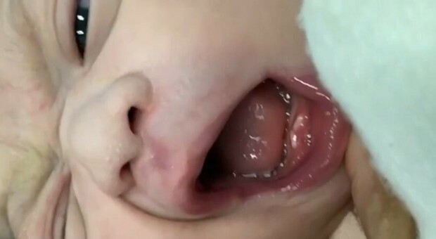 Bimba nasce con due dentini, succede una volta ogni duemila nascite