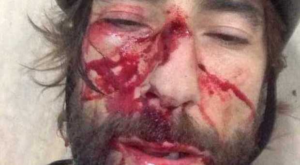 Brumotti, ancora una caduta in bicicletta: su Instagram la foto del volto tumefatto