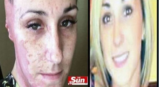 Adele, 23 anni, sfigurata con l'acido dall'ex fidanzato: "Ho sentito che mi colava la faccia"