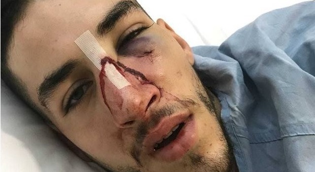 Aggredito da un avversario, giovane calciatore finisce in ospedale: operato