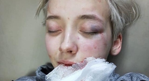Ragazza lesbica di 18 anni aggredita da 7 uomini perché omosessuale. Le foto choc in rete