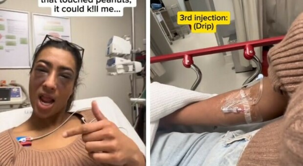Allergica alle noccioline, tiktoker va in ospedale: «Ho rischiato di morire». E filma tutto con lo smartphone