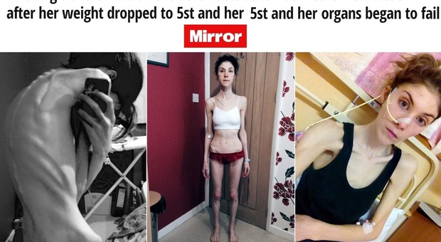 L'anoressia rischia di ucciderla, salvata in extremis: "Ora sono guarita" (Mirror.co.uk)