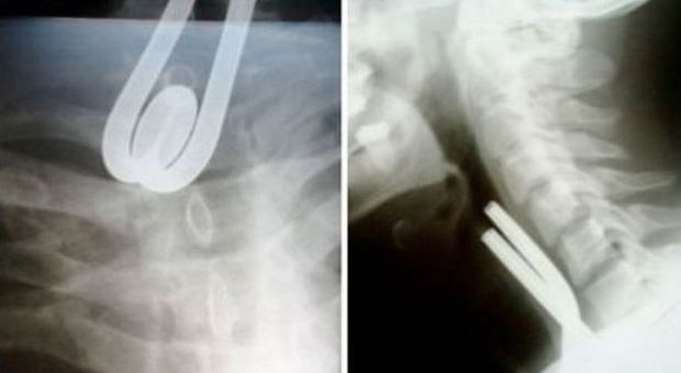 Va in ospedale con un forte mal di gola: I medici fanno una scoperta scioccante