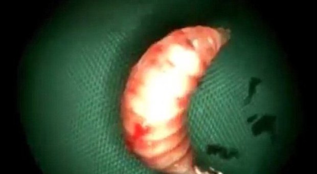 Ha fastidio al naso, medici scoprono decine di vermi che gli stavano mangiando il volto