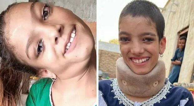 Cade a 10 mesi e il collo resta storto, rendendola invalida: la 13enne rinasce dopo un delicato intervento chirurgico