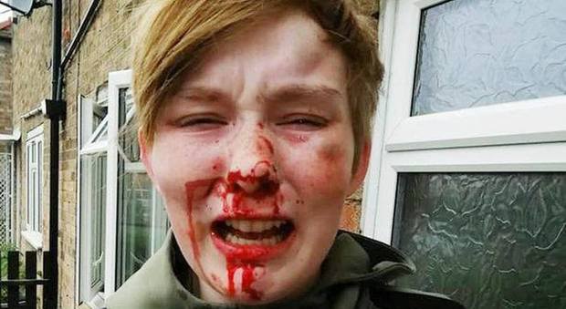 «Fottuta lesbica», diciottenne aggredita da due ragazze: il volto è una maschera di sangue La foto choc