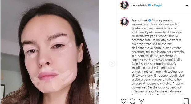 Kasia Smutniak crea un filtro su Instagram con la vitiligine: «Ecco la bellezza della diversità»