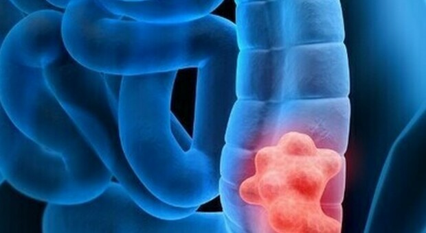 Cancro al colon, i ricercatori del Cnr di Napoli: «La cura con un sistema intelligente»