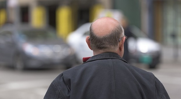 Usa, scoperto per caso: il trattamento per l'artrite può curare l'alopecia