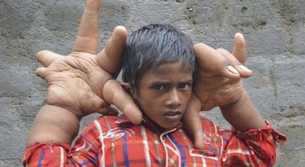 Kaleem ha le mani più grandi della testa: vittima di bullismo, costretto a lasciare la scuola