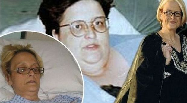 Perde 170 chili con bendaggio gastrico: muore per le complicazioni 16 anni dopo
