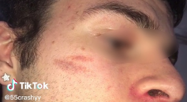 La 'cicatrice francese', ultima follia di TikTok: ragazzini si sfregiano il volto per avere più like VIDEO