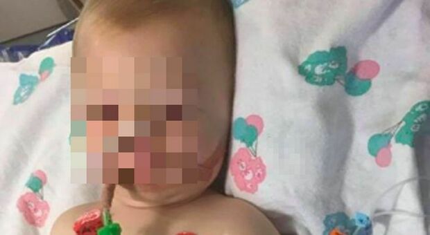 Ingoia una capsula di detersivo, bambina di 10 mesi in coma