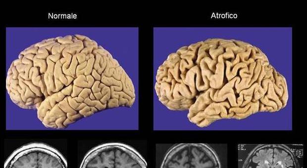 Cervello dei giovani, alcol e droga danneggiano come l'Alzheimer