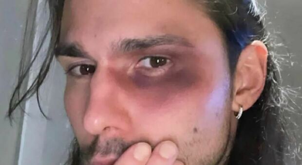 Luca Onestini, occhio nero per difendere la fidanzata durante una rissa tra tifosi