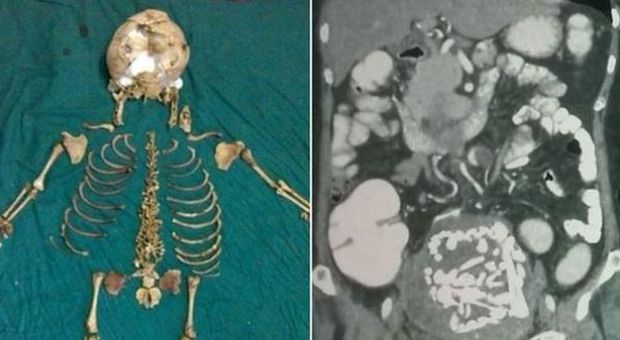 Vive per 36 anni con lo scheletro del bimbo mai nato nella pancia