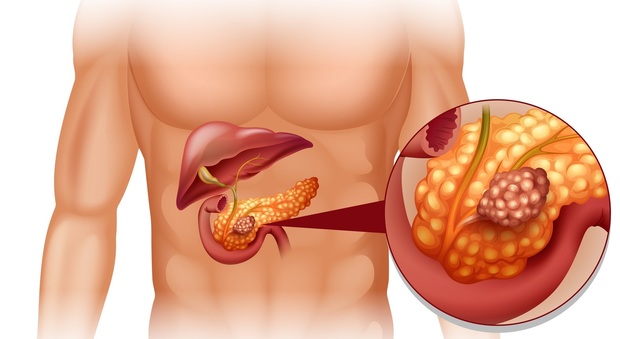 In crescita il pericolo dei tumori al pancreas: ecco i fattori di rischio