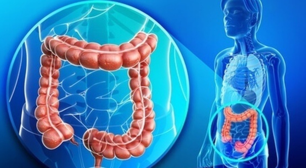 Malattia di Chron, uno studio rivela che una dieta può portare alla remissione