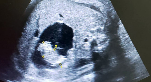 Neonata nasce col feto della gemellina in grembo: il caso rarissimo