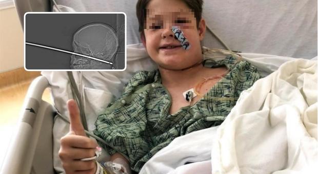 In ospedale con uno spiedo conficcato nel cranio, bimbo di 10 anni salvo per miracolo