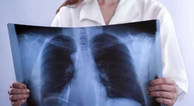 Tumore al polmone, presentati a Napoli i nuovi protocolli di cura