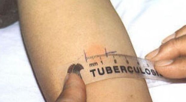 Allarme tubercolosi al San Bassiano Un caso accertato, dubbi su 40enne