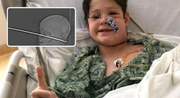 Usa, spiedo conficcato nel cranio: bimbo di 10 anni salvo per miracolo