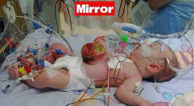 La piccola Nell, bimba coraggiosa: è nata con stomaco e intestino fuori dal corpo