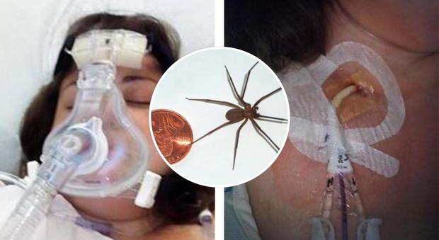 Morsa da un ragno mentre dorme, rischia la morte a 29 anni