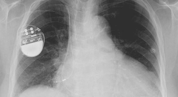 Dispositivi biomedici a rischio hacker: anche un pacemaker potrebbe essere manomesso