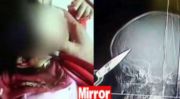 Bimba di 2 anni si trafigge il cranio con le forbici. I genitori: "Eravamo troppo impegnati in cucina"