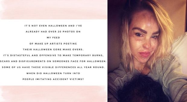 Halloween, modella sfregiata: "No a maschere con ferite e cicatrici"