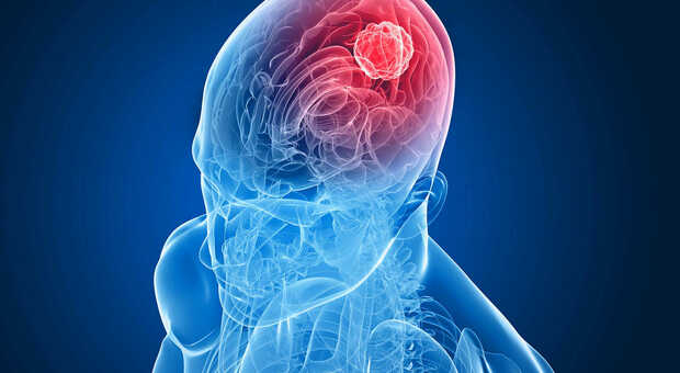Tumore al cervello, nuova terapia americana elimina le cellule cancerogene e previene la recidiva