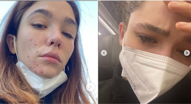 Matilda De Angelis, l'ansia, la sofferenza e l'acne. Lo sfogo su Instagram: «Imparate a chiedere aiuto»