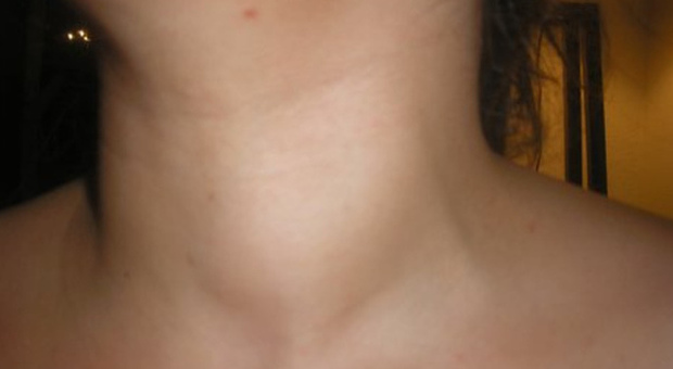 Nuove tecniche laser per gli interventi alla tiroide: esperti a confronto