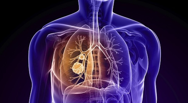 Tumore al polmone, efficace la combinazione "immunoterapia-chemio"