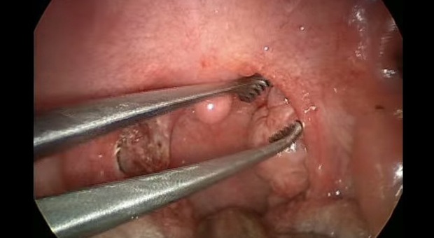 Ecco come vengono rimosse le tonsille: il video è il più cliccato su YouTube