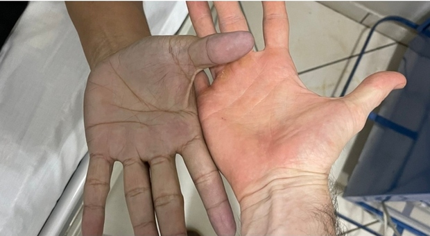 Paziente si presenta al pronto soccorso con le mani blu, Medici perplessi, la diagnosi è sorprendente