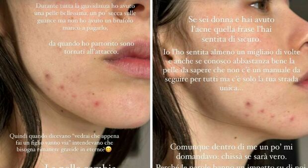 Aurora Ramazzotti mostra la pelle rovinata dall'acne: «Dopo la gravidanza è ricomparso. Non credete a chi pensa di sapere tutto»
