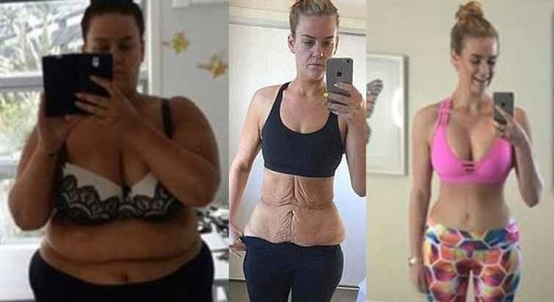 Simone Anderson prima della dieta, dopo con gli eccessi di pelle e post intervento chirurgico (Instagram)