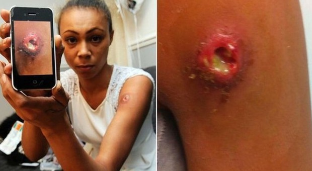 Un ragno killer le morde il braccio nel sonno: "Mi ha paralizzata per quattro giorni"