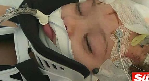 Babysitter 16enne ferisce gravemente bimba di 2: "Rubava il dolce"