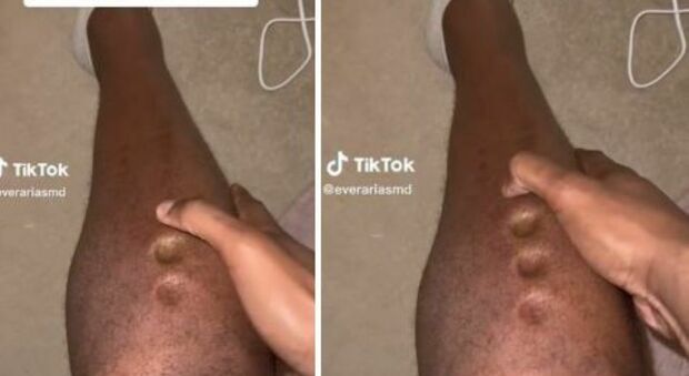 La pelle si trasforma in gomma, scopre di essere gravemente malato grazie al video TikTok