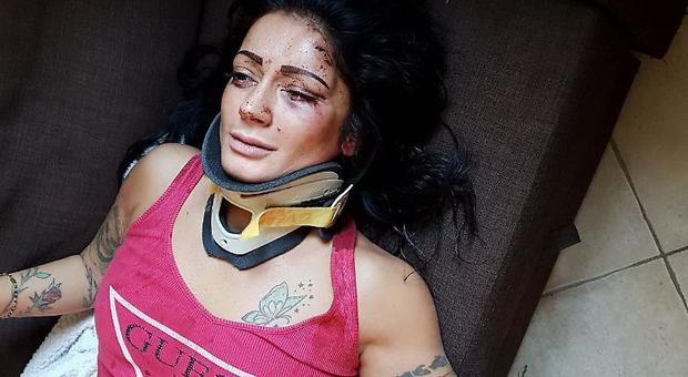 Cremona, ballerina romena aggredita in casa: su Fb le foto choc dopo il pestaggio