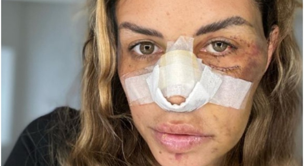 Carlotta Adacher, la foto choc dopo l'incidente: «Temevo di non poter più riaprire gli occhi»