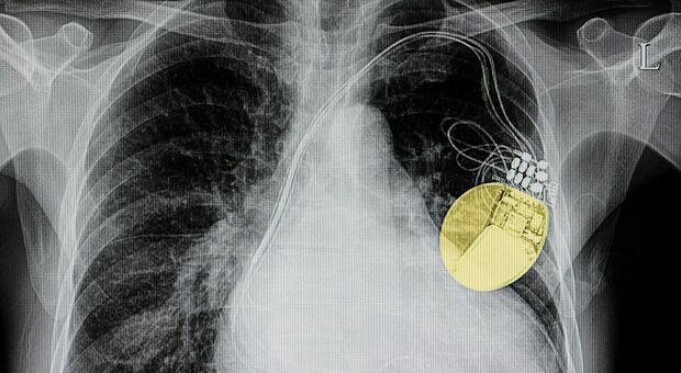 Impiantato primo pacemaker senza elettrodi in un paziente di 36 anni a Messina
