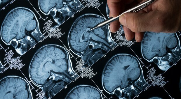 Alzheimer, lavori altamente stimolanti difendono dalla malattia: legati anche a ridotti livelli molecole neurotossiche nel sangue