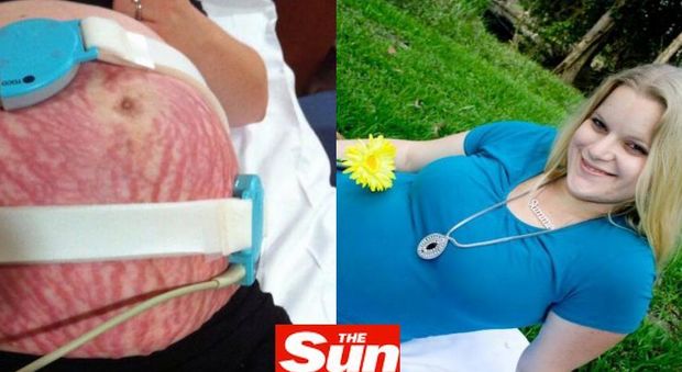 Summer Bostock, 29 anni, australiana. In gravidanza si riempie di macchie: "Mio corpo era allergico al feto"